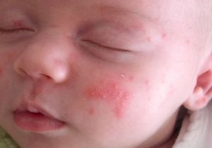 میلیا، آکنه و اگزما، عوارض پوستی شایع نوزادان